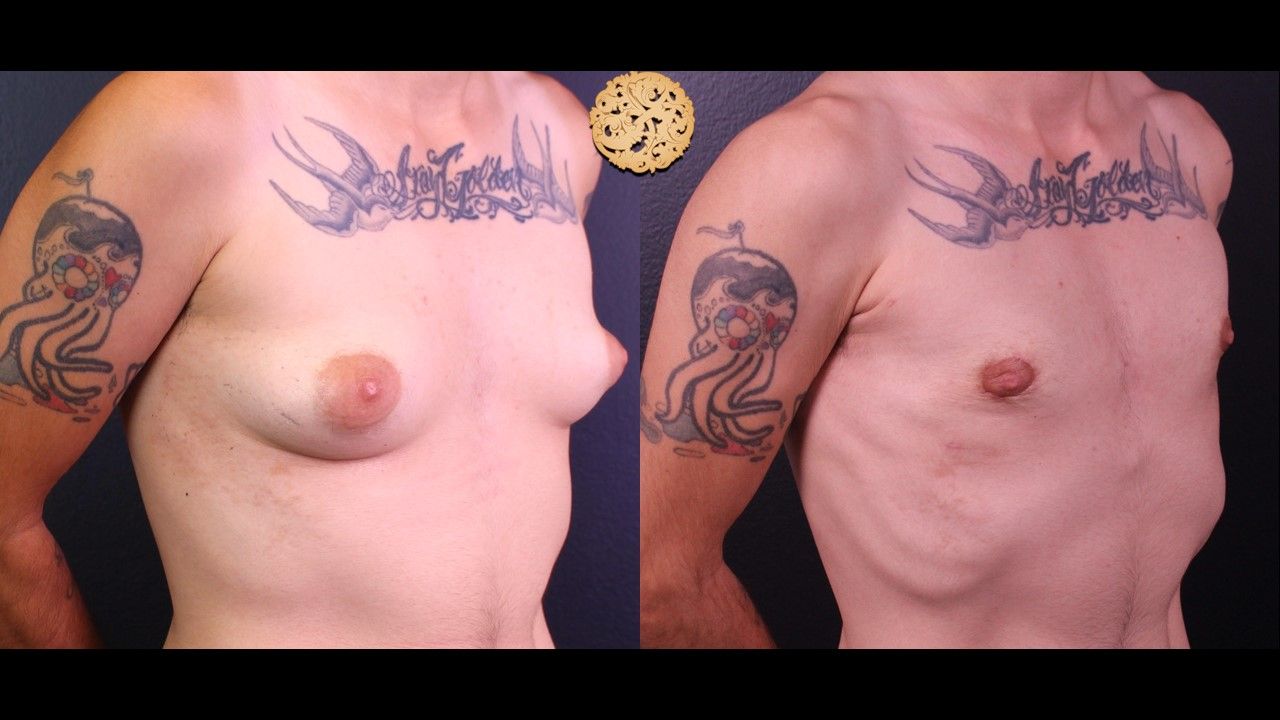 Ftm Top Surgery Before & After