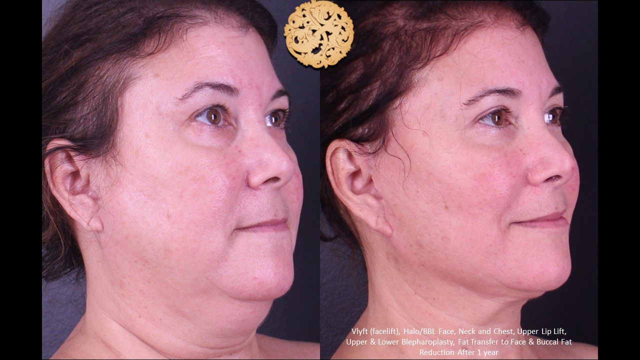Upper Blepharoplasty Before & After