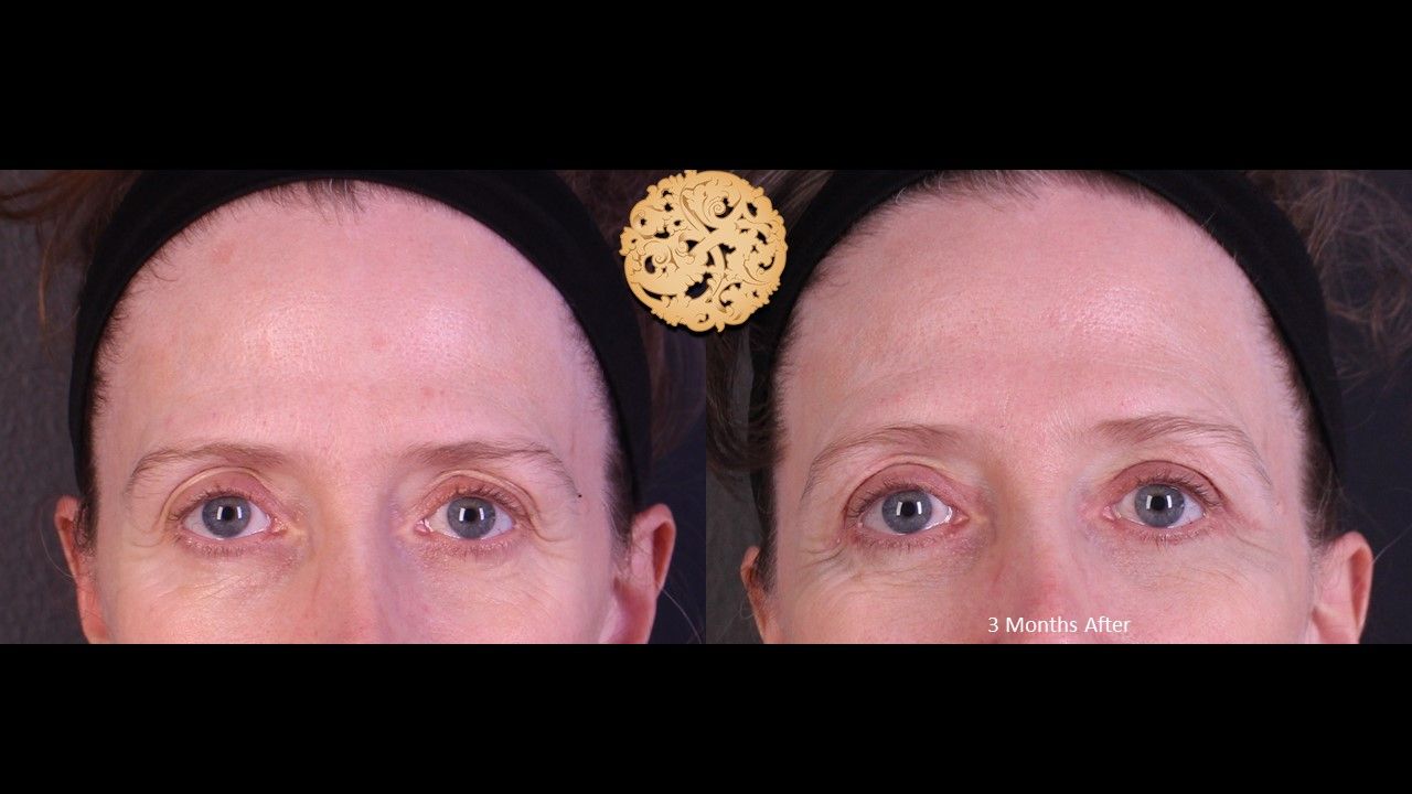 Upper Blepharoplasty Before & After
