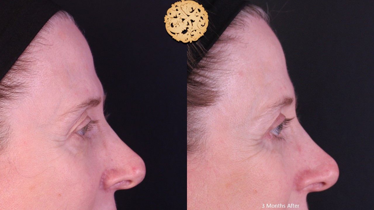 Upper Blepharoplasty Before & After