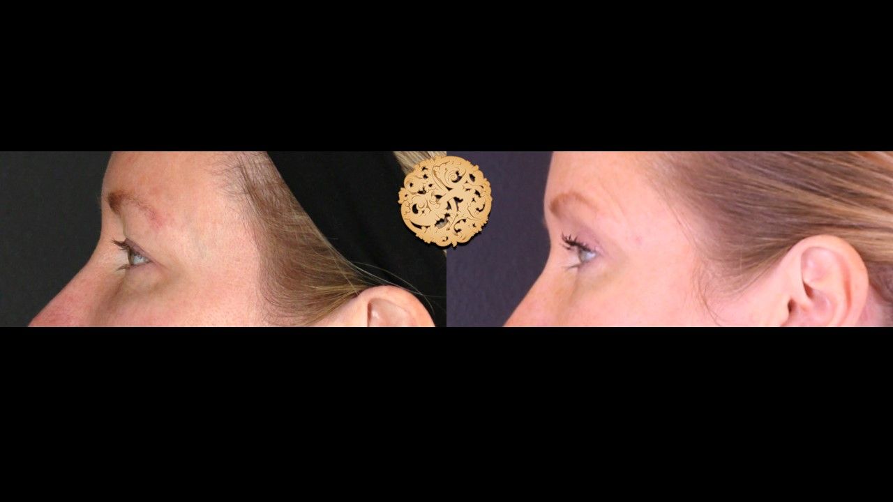 Upper Blepharoplasty Before & After