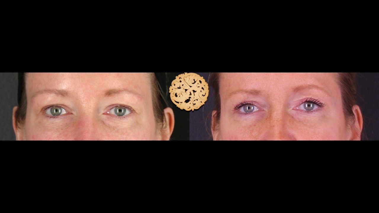 Upper Blepharoplasty Before & After