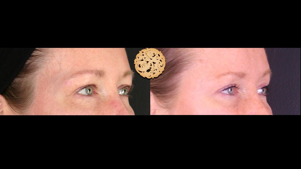 Upper Blepharoplasty Before & After