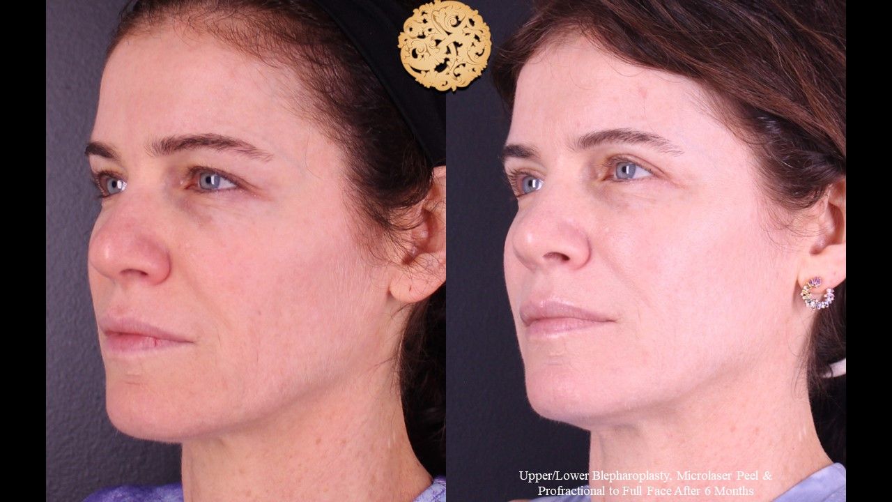 Upper Blepharoplasty Before & After