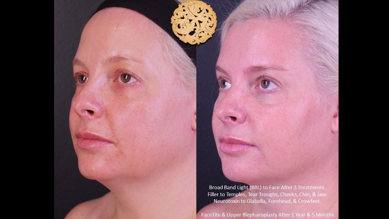 Upper Blepharoplasty Before & After
