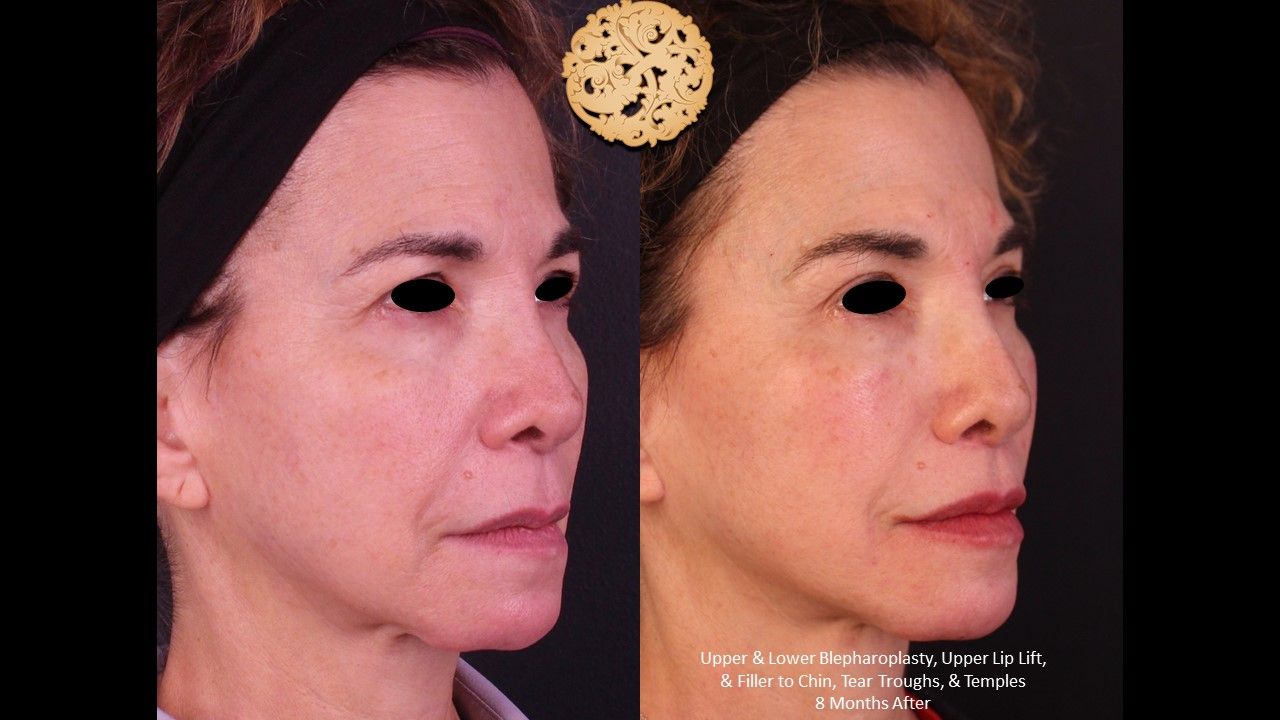 Upper Blepharoplasty Before & After