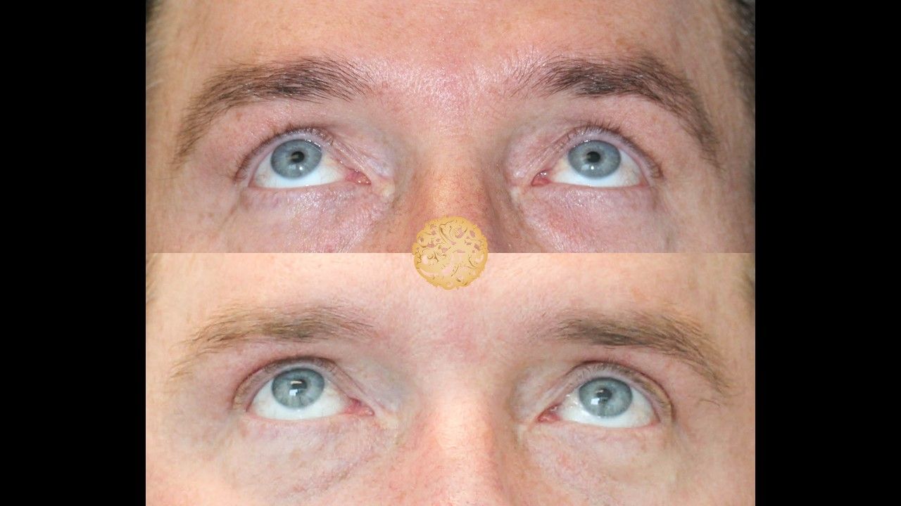 Upper Blepharoplasty Before & After