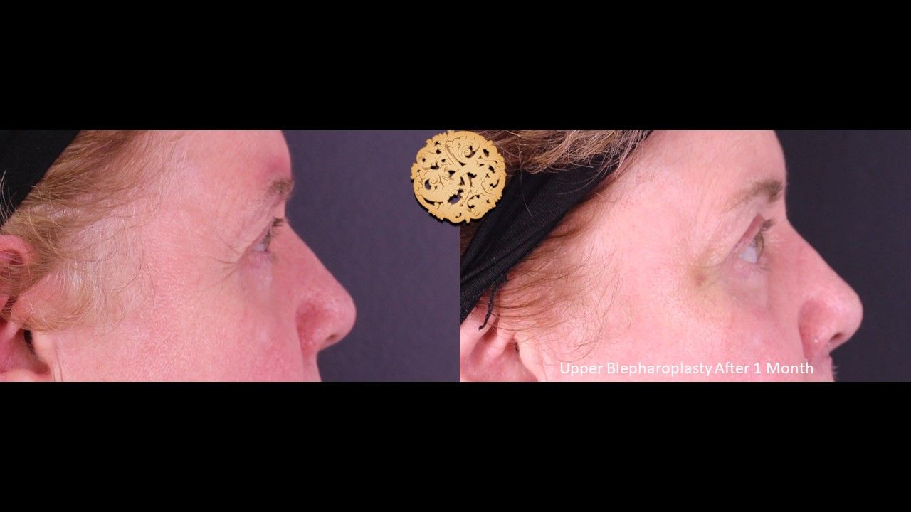 Upper Blepharoplasty Before & After
