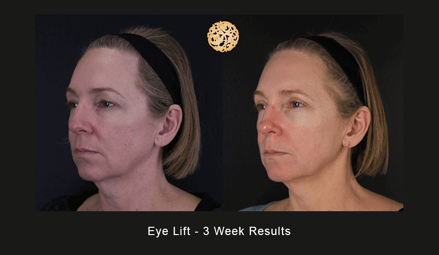 Upper Blepharoplasty Before & After