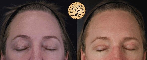 Upper Blepharoplasty Before & After