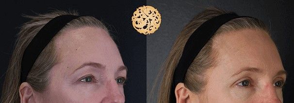 Upper Blepharoplasty Before & After