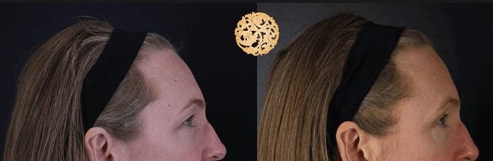 Upper Blepharoplasty Before & After