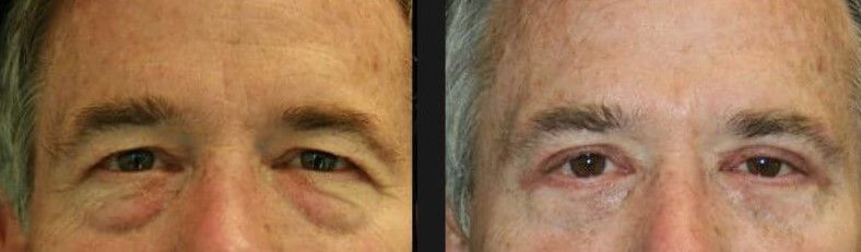Upper Blepharoplasty Before & After