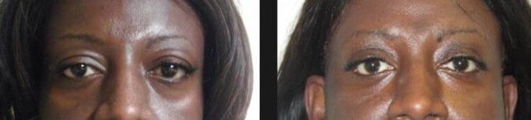 Upper Blepharoplasty Before & After