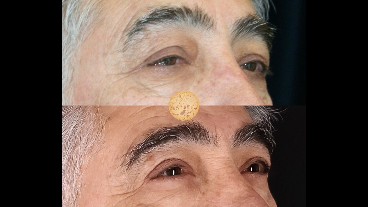 Upper Blepharoplasty Before & After