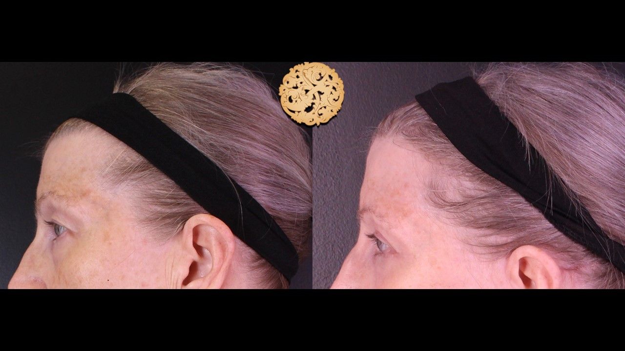 Upper Blepharoplasty Before & After