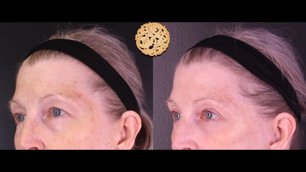 Upper Blepharoplasty Before & After