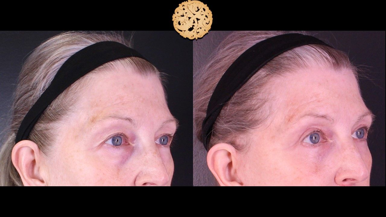 Upper Blepharoplasty Before & After