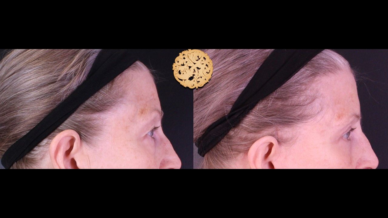 Upper Blepharoplasty Before & After