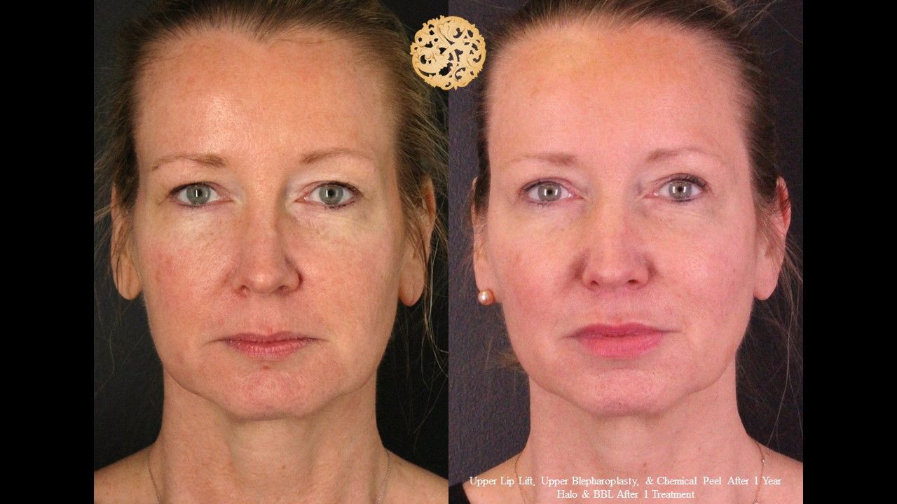 Upper Blepharoplasty Before & After