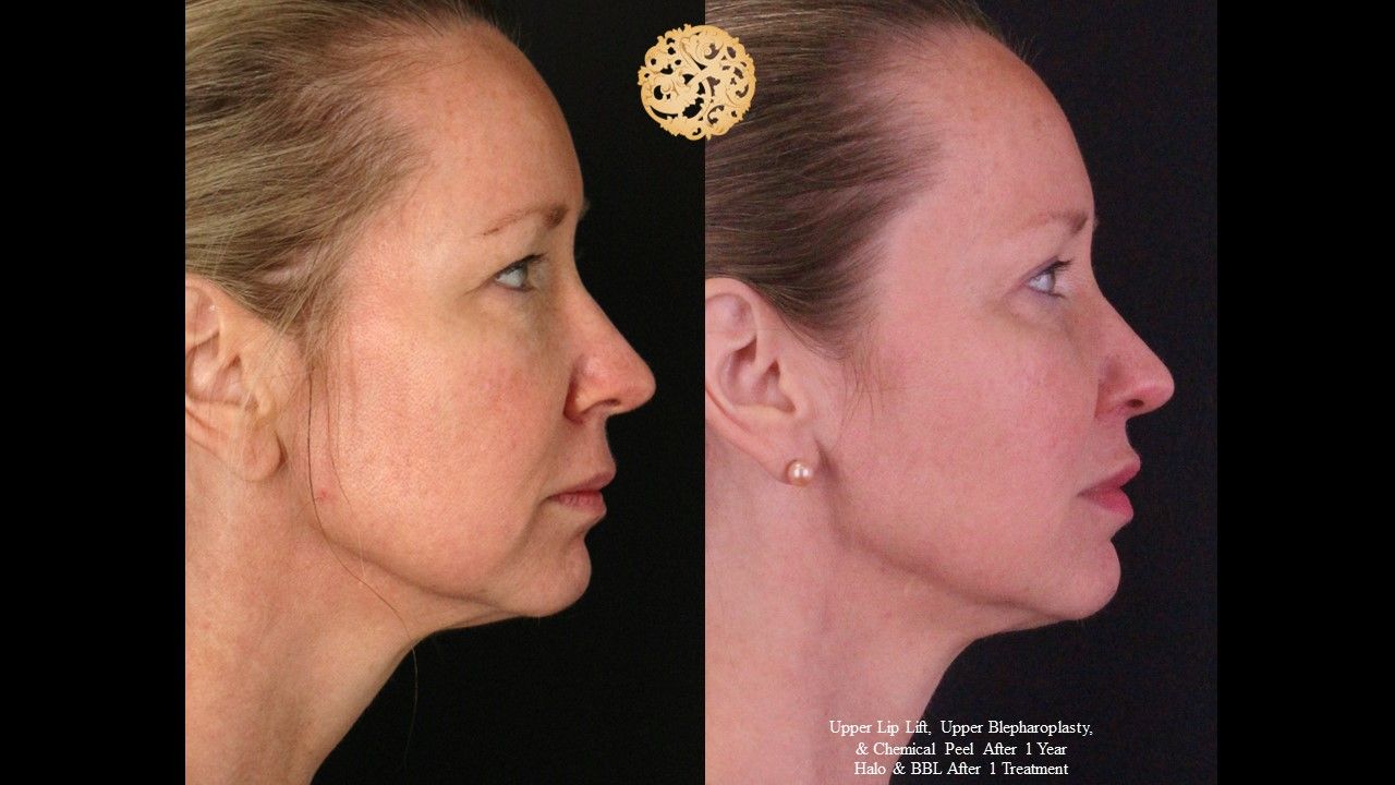 Upper Blepharoplasty Before & After