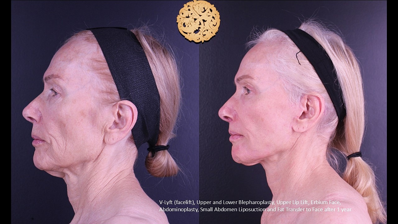 Upper Blepharoplasty Before & After
