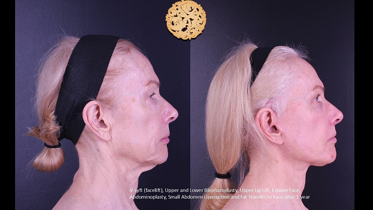 Upper Blepharoplasty Before & After