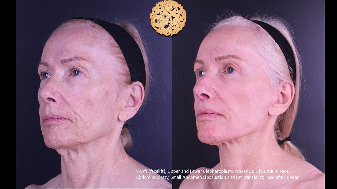 Upper Blepharoplasty Before & After