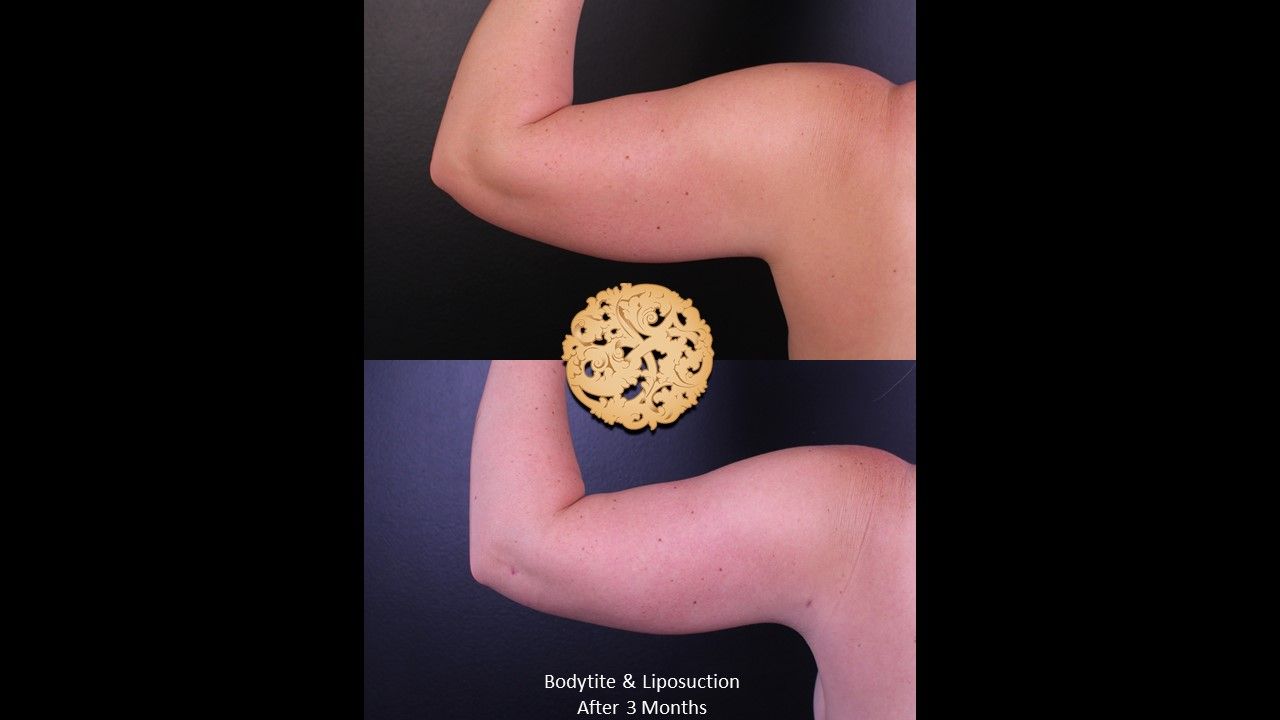 Liposuction Arms Before & After