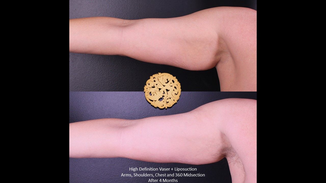 Liposuction Arms Before & After