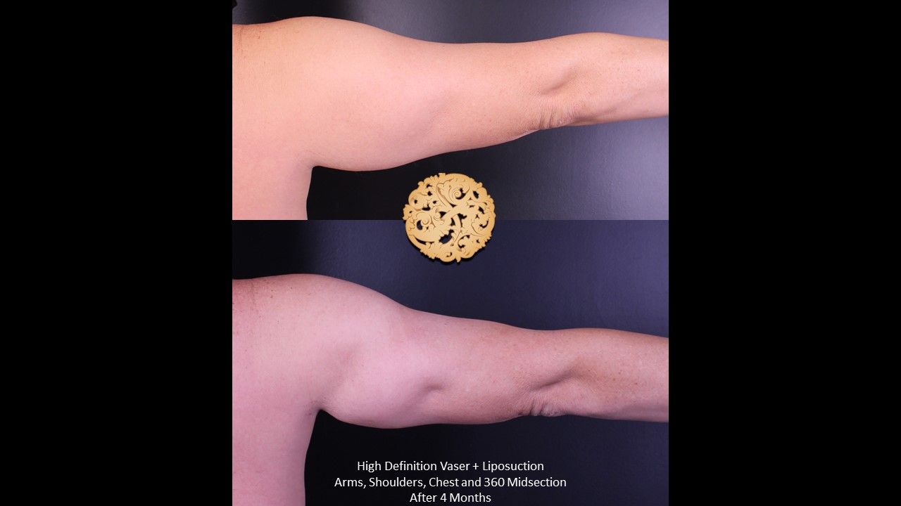 Liposuction Arms Before & After