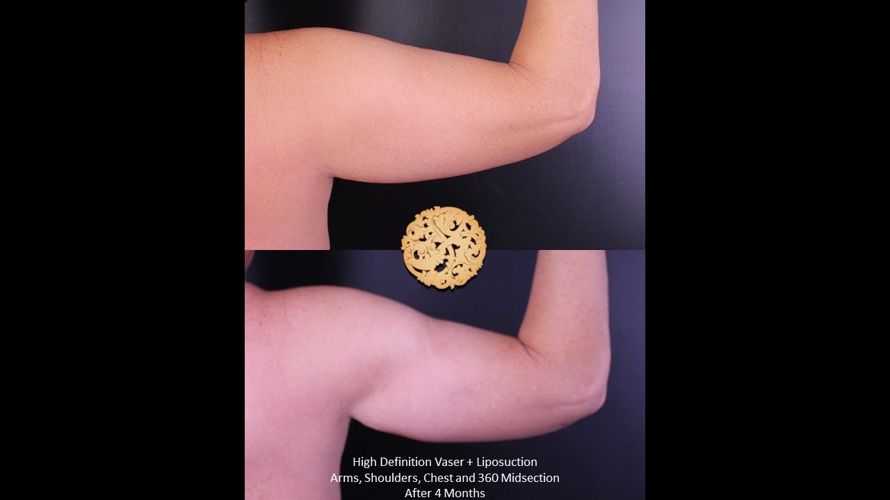 Liposuction Arms Before & After