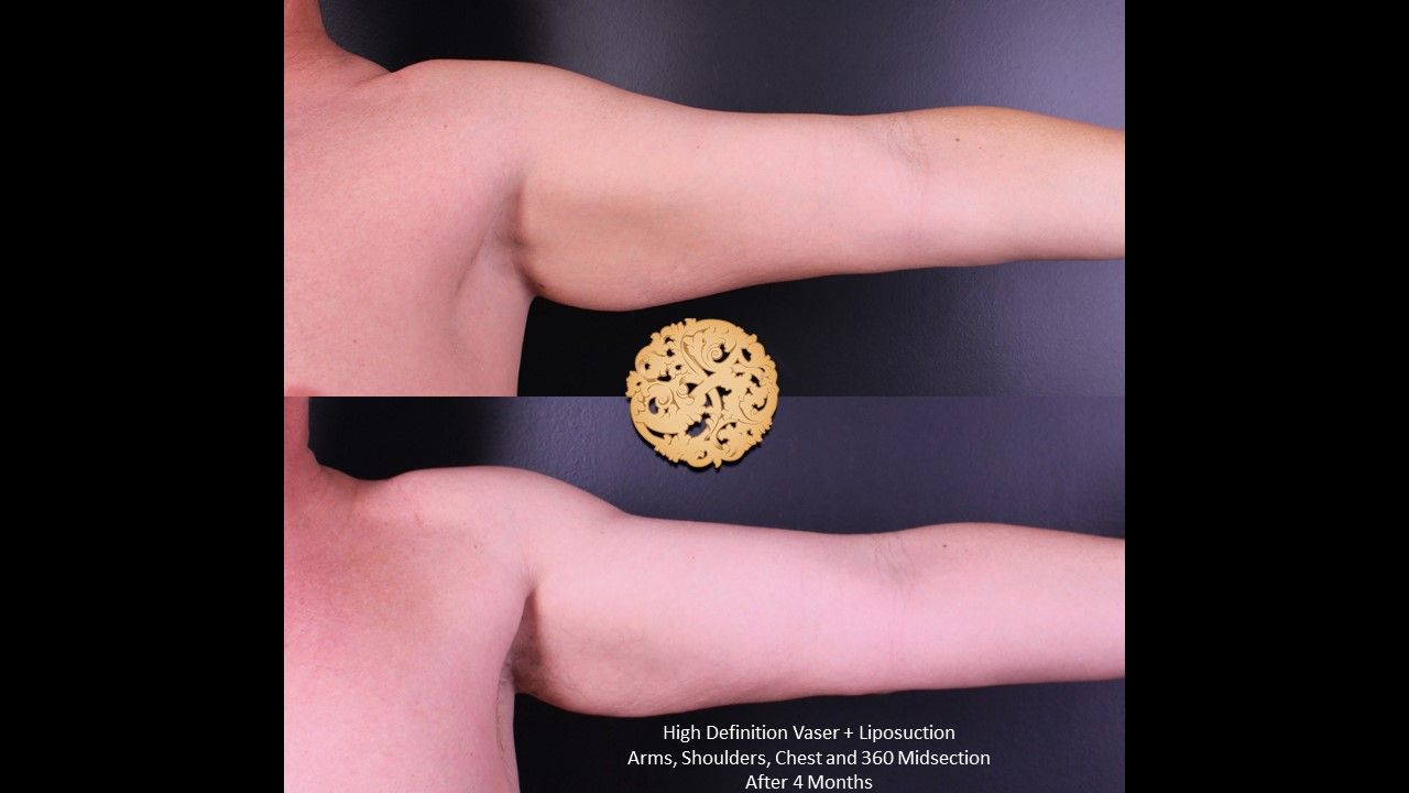 Liposuction Arms Before & After
