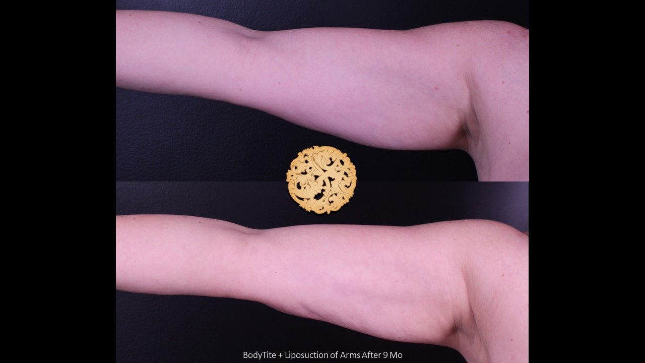 Liposuction Arms Before & After