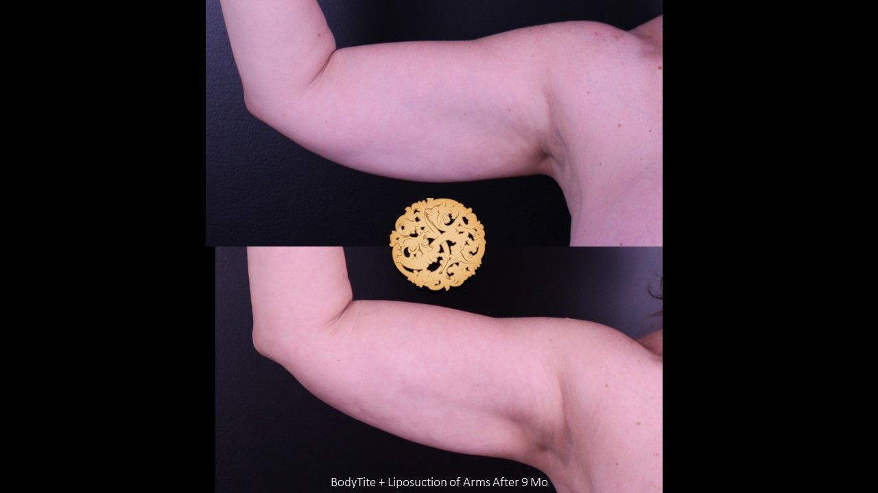Liposuction Arms Before & After