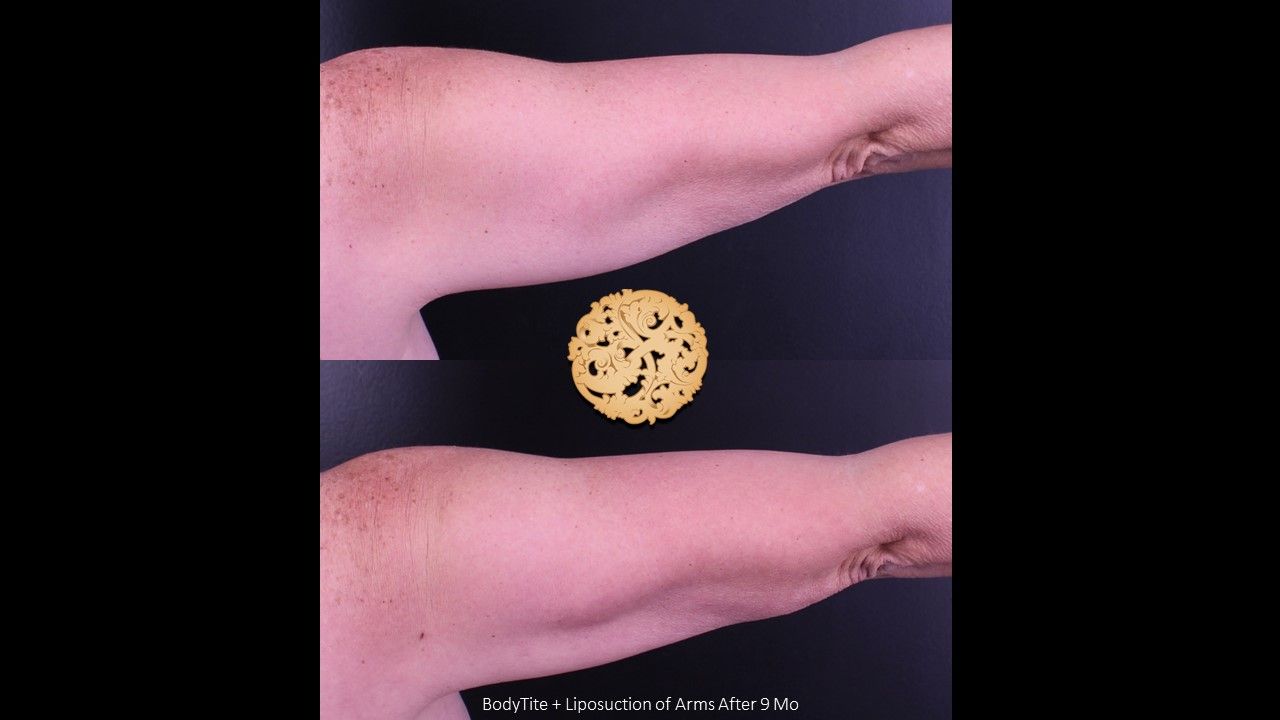 Liposuction Arms Before & After