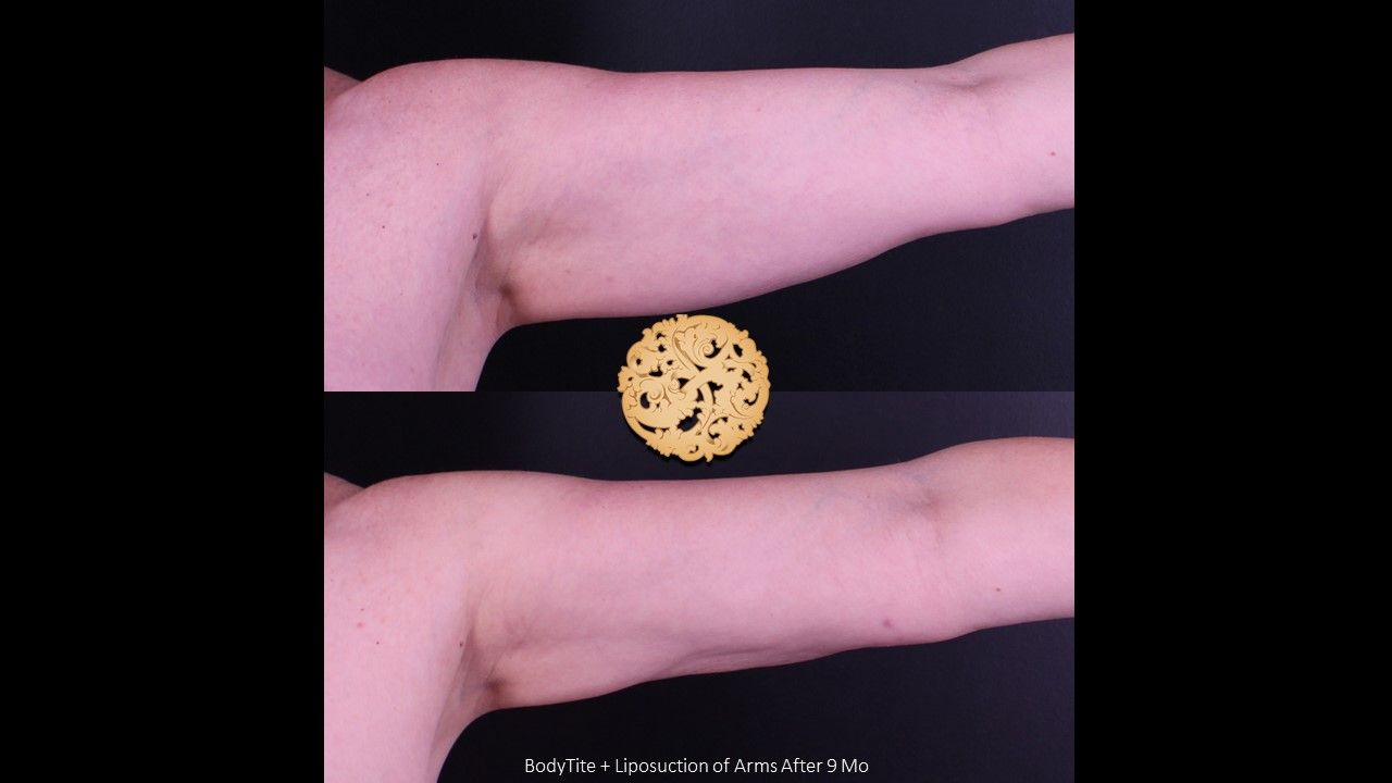 Liposuction Arms Before & After