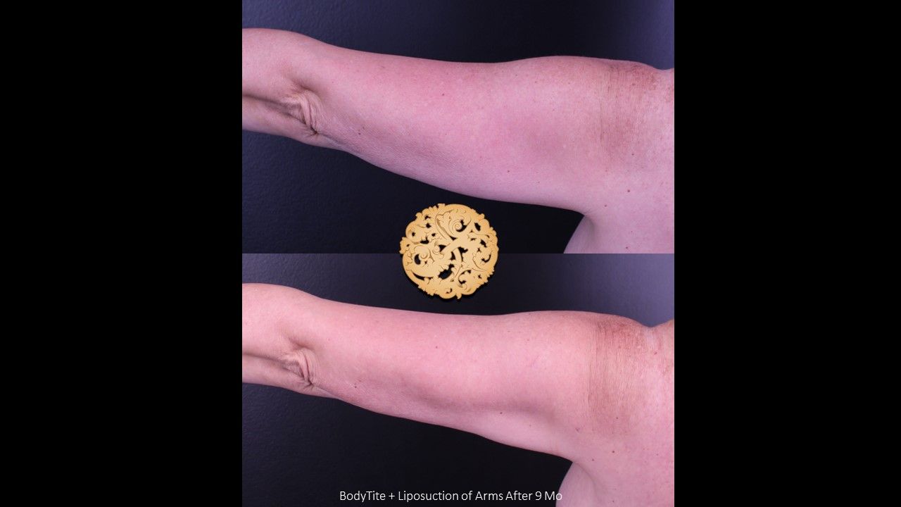Liposuction Arms Before & After