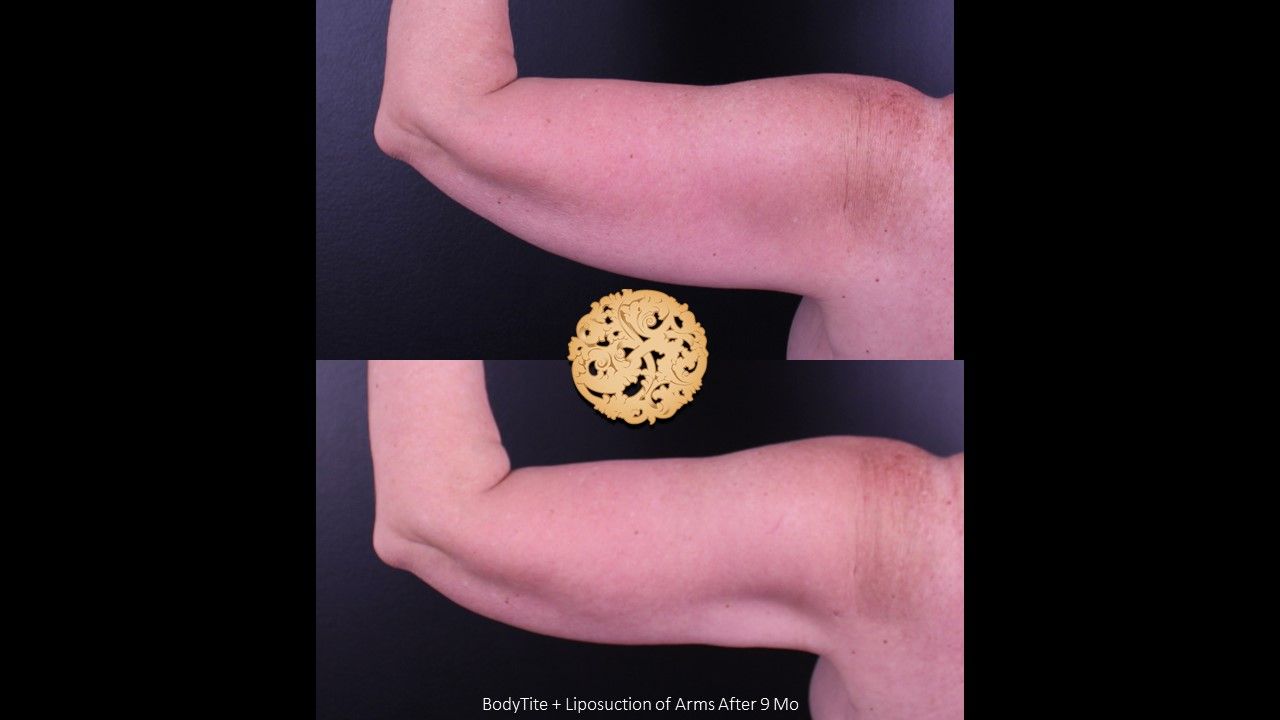 Liposuction Arms Before & After