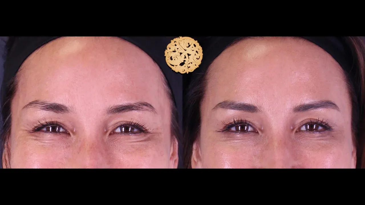 Xeomin Before & After