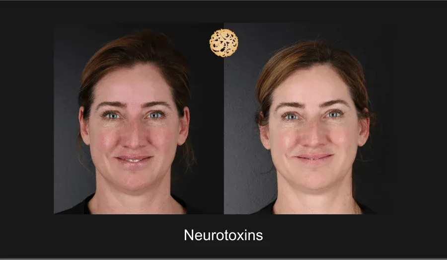 Xeomin Before & After