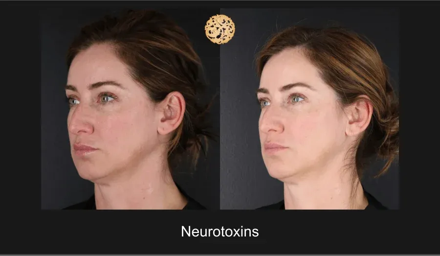 Xeomin Before & After