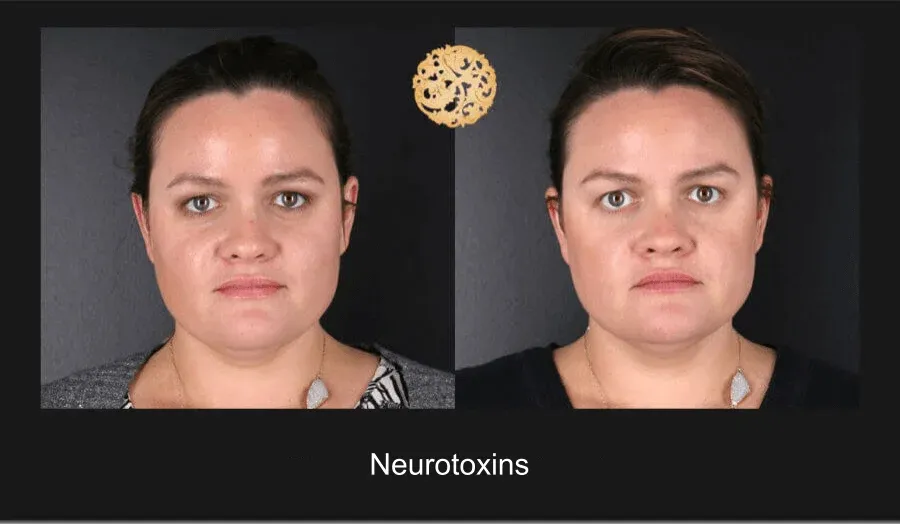 Xeomin Before & After