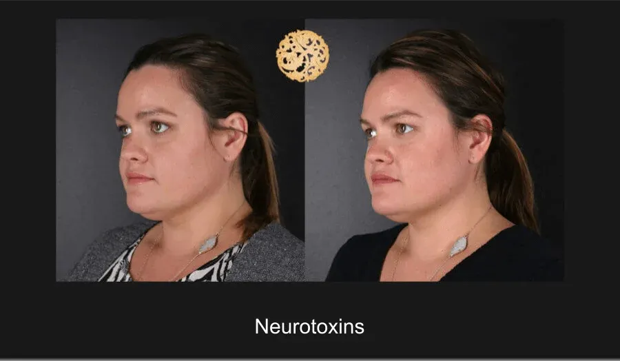 Xeomin Before & After