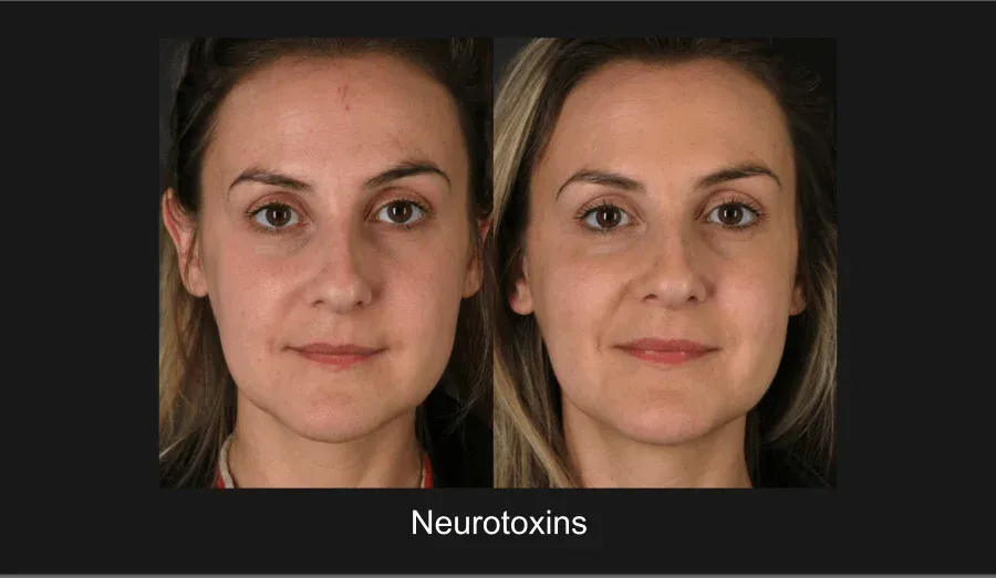 Xeomin Before & After