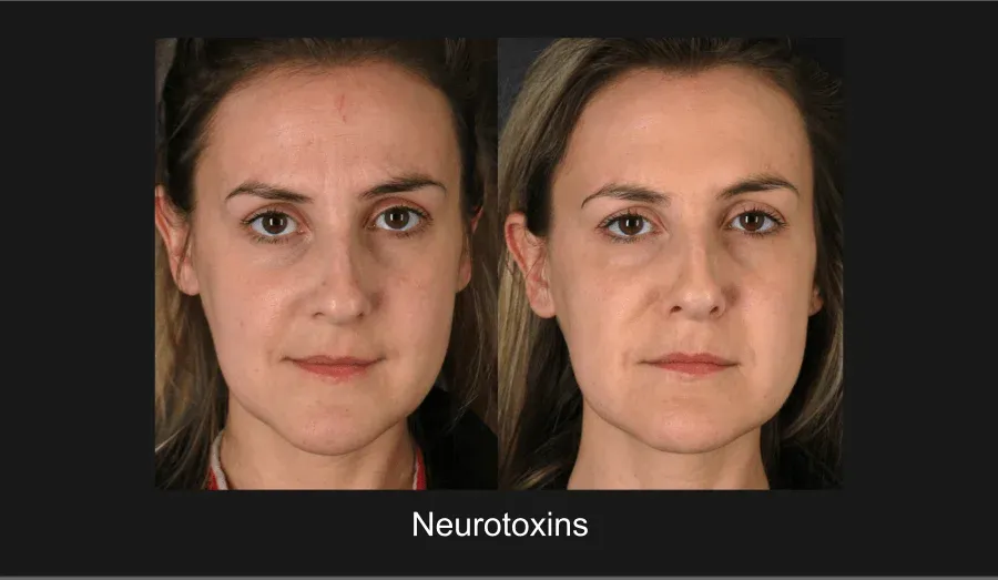 Xeomin Before & After