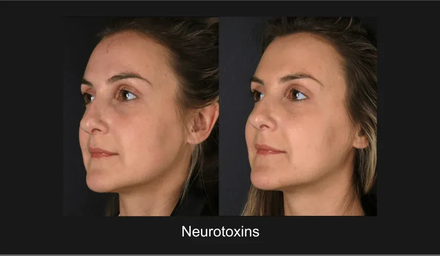 Xeomin Before & After