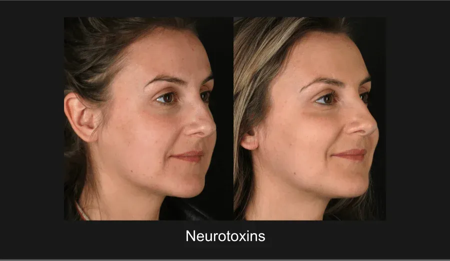Xeomin Before & After