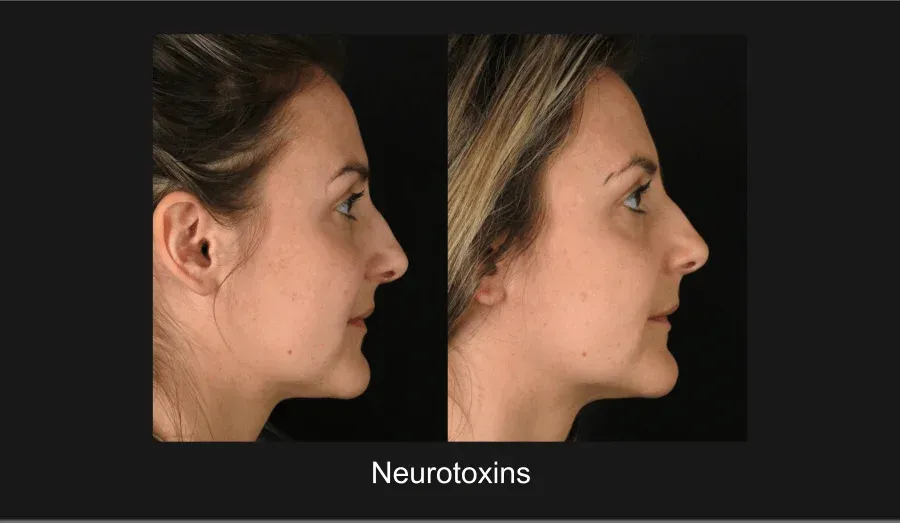 Xeomin Before & After