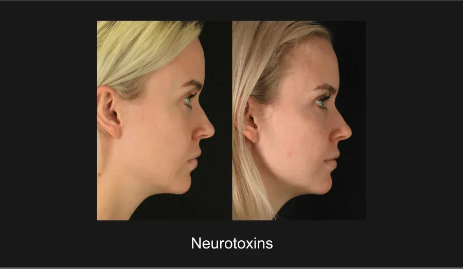 Xeomin Before & After
